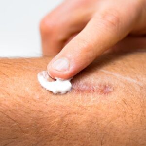 scar healing cream